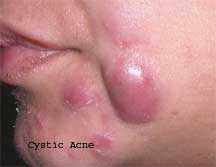 Cystic-Acne